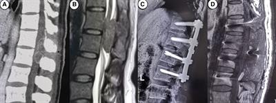 Three-dimensional simulation/printing-assisted surgery for symptomatic metastatic epidural spinal cord compression of posterior column: efficacy assessment based on 2-year follow-up